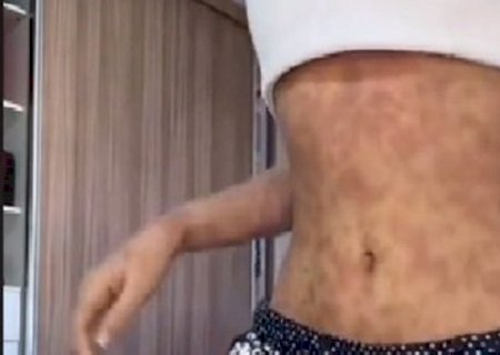 Influenciadora fica toda pintada após tratamento para dor de garganta