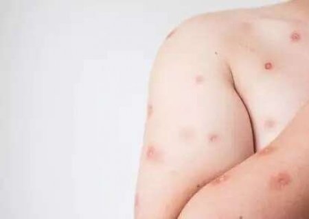 Ministério da Saúde confirma primeiro caso de nova cepa de Mpox no Brasil